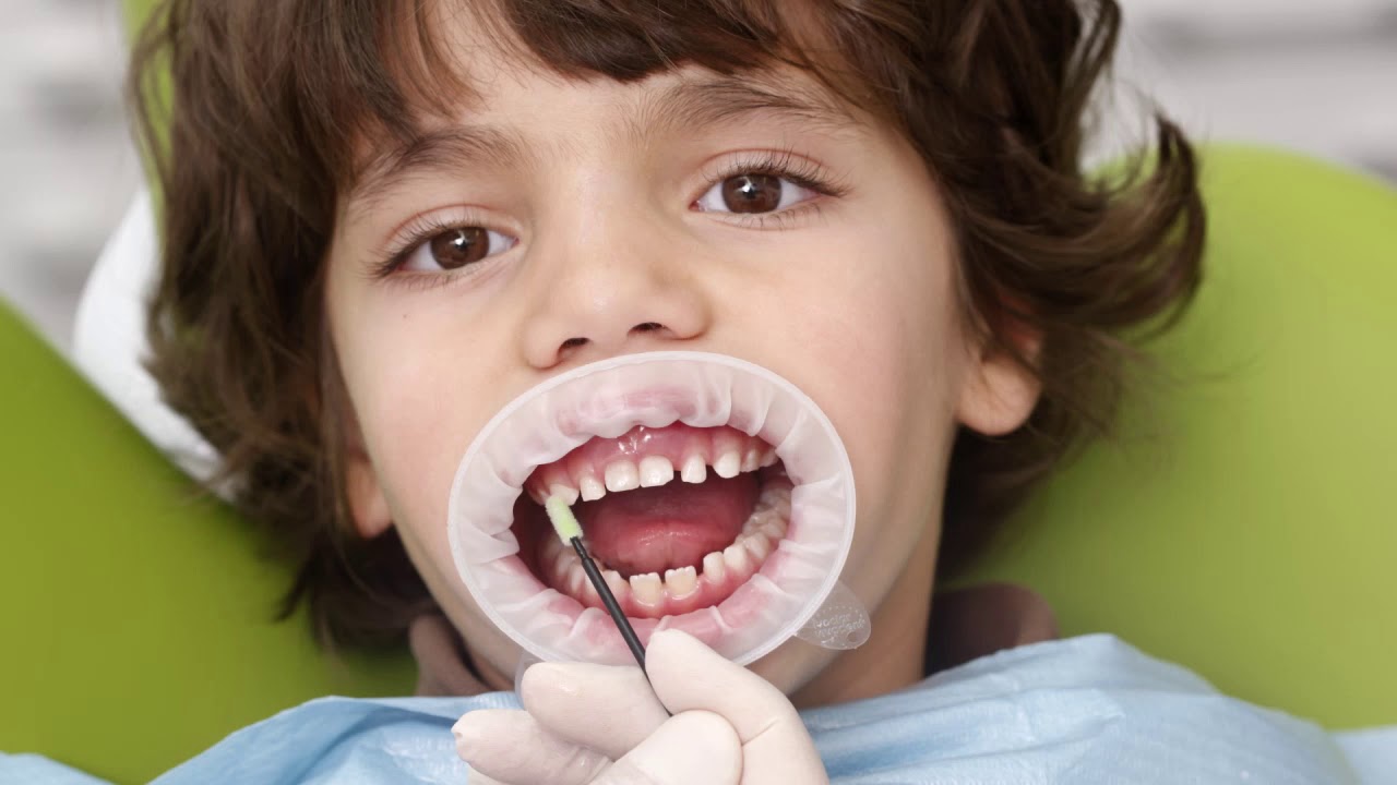 Aplicación tópica de flúor (solo en niños)